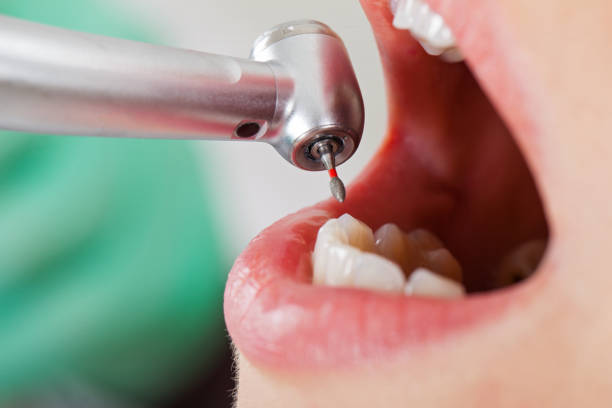 Best Emergency Dental Care for Broken or Chipped Teeth in Mammoth Lakes, CA